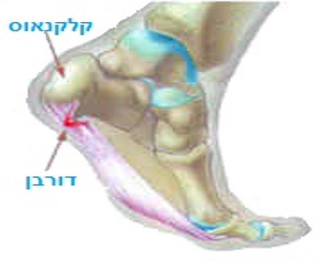 דורבן בכף הרגל